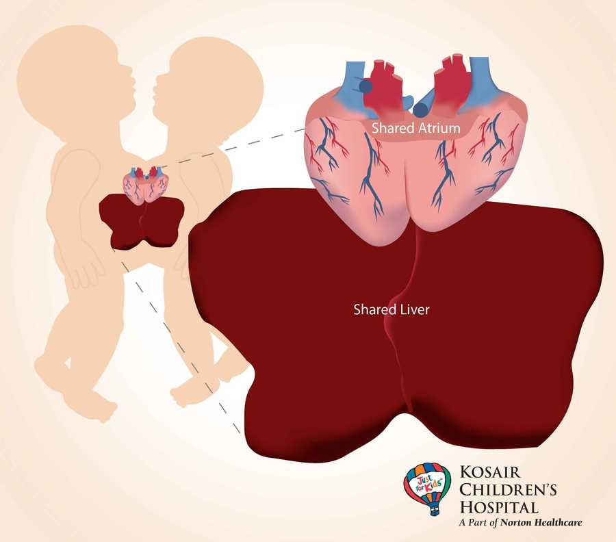 Louisville surgeons last week successfully separated 7-week-old conjoined twins at Kosair Children’s Hospital.