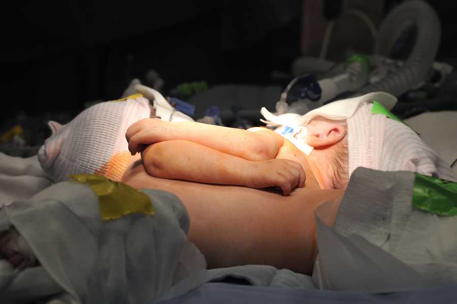 The baby girls before surgery